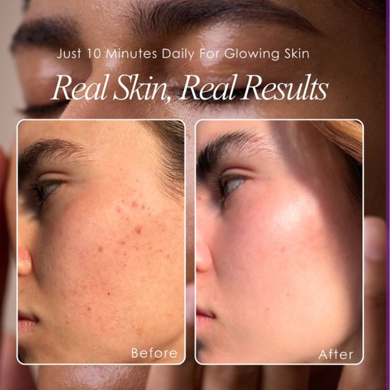 Wrinkleless Face Lifter Strips
